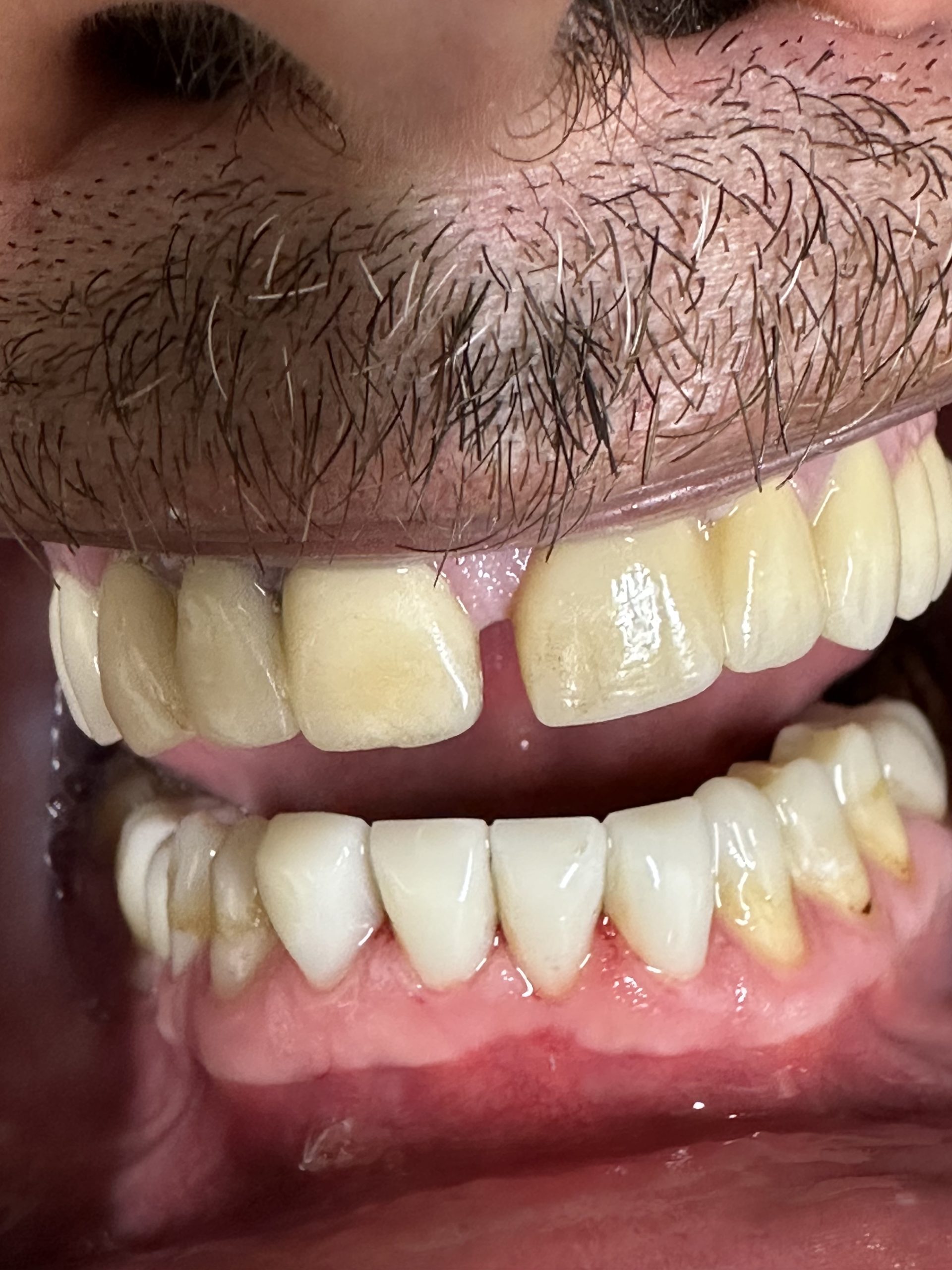 Full Mouth Reconstruction