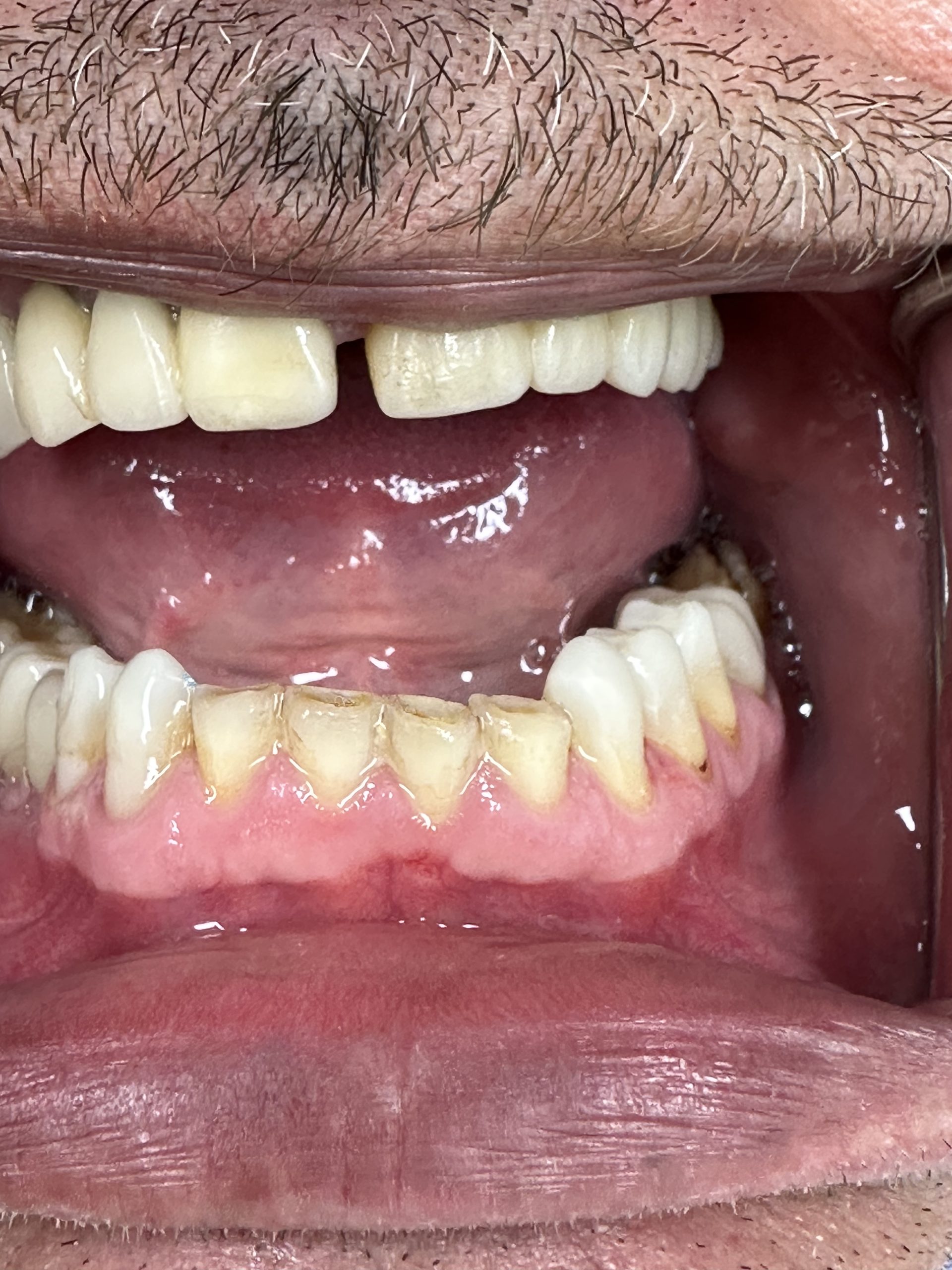 Full Mouth Reconstruction