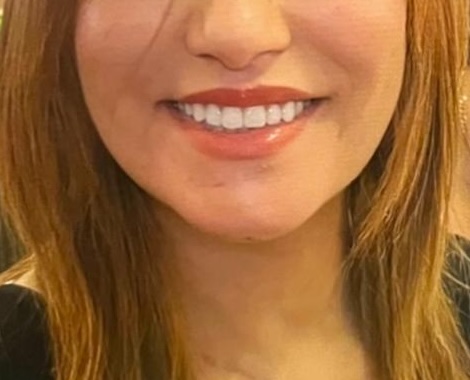 Full Mouth Reconstruction