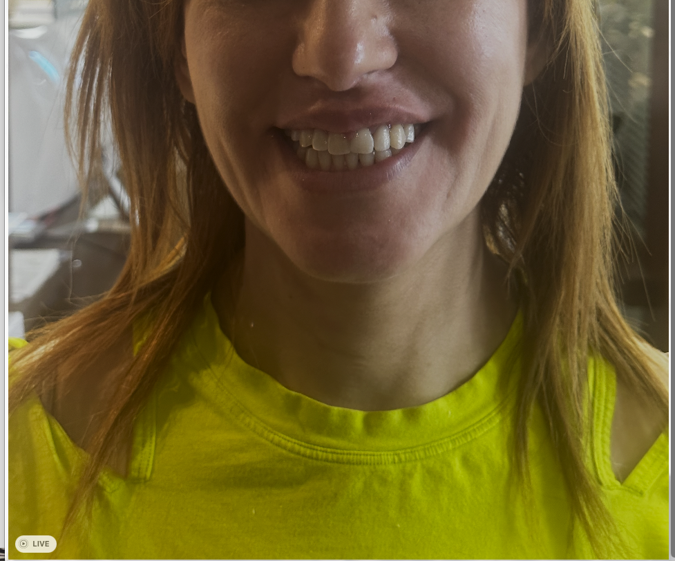 Full Mouth Reconstruction