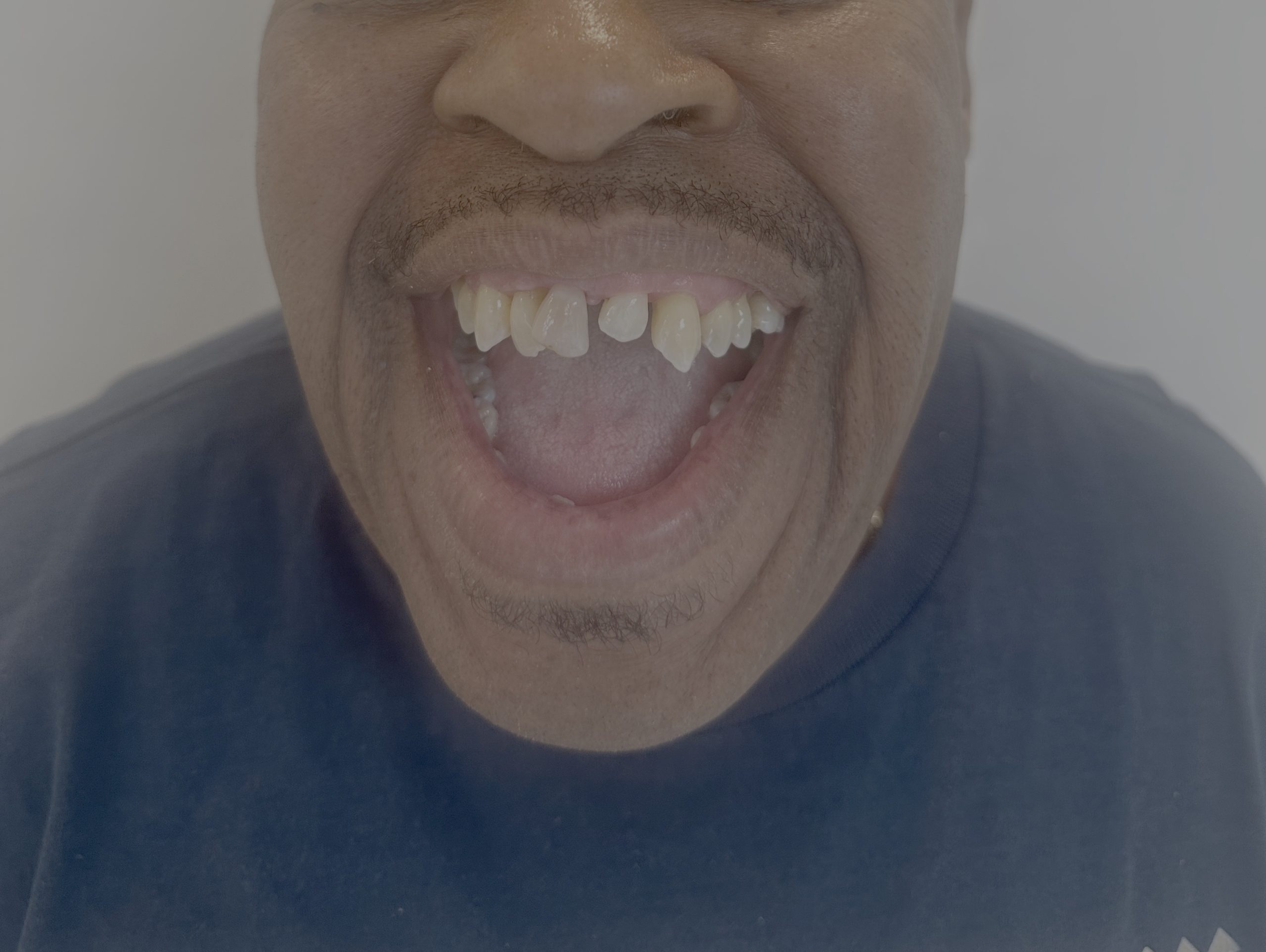 Full Mouth Reconstruction