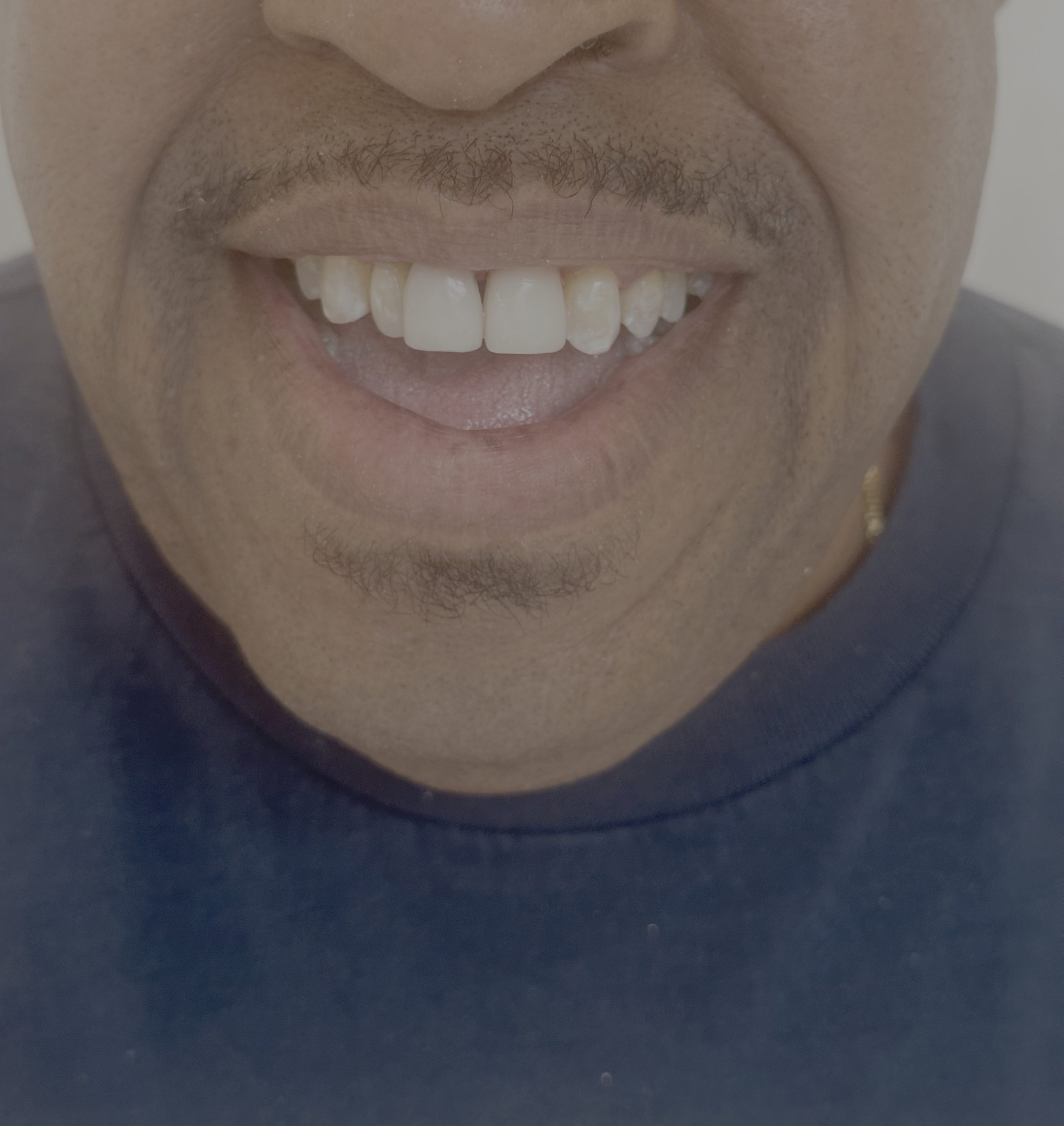 Full Mouth Reconstruction