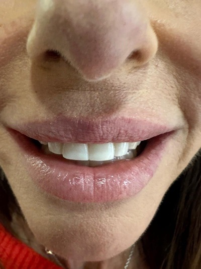 Full Mouth Reconstruction