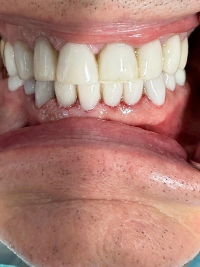 Full Mouth Reconstruction
