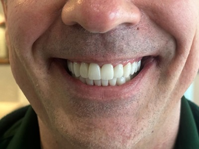 Full Mouth Reconstruction