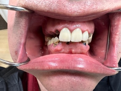 Full Mouth Reconstruction
